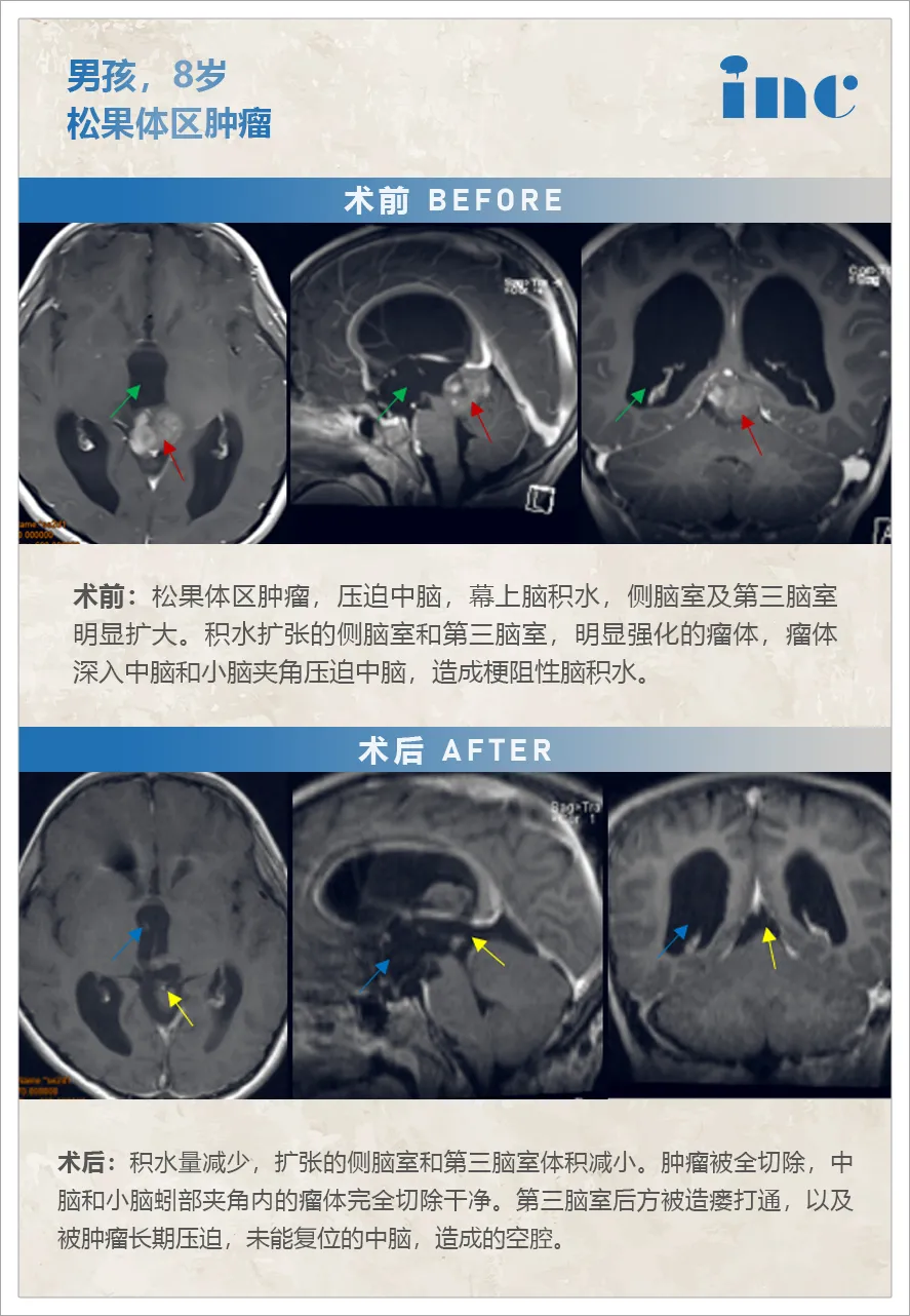 男孩，8岁松果体区肿瘤 术前:松果体区肿瘤，压迫中脑，幕上脑积水，侧脑室及第三脑室明显扩大。积水扩张的侧脑室和第三脑室，明显强化的瘤体，瘤体深入中脑和小脑夹角压迫中脑，造成梗阻性脑积水。 术后:积水量减少，扩张的侧脑室和第三脑室体积减小。肿瘤被全切除，中脑和小脑蚓部夹角内的瘤体完全切除干净。第三脑室后方被造瘘打通，以及被肿瘤长期压迫，未能复位的中脑，造成的空腔。