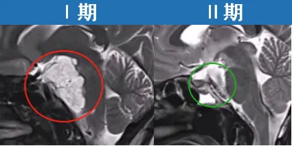 分期手术、成功全切