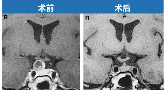 这是一个发表于2003年的<a href='/naochuitiliu/' target='_blank'><u>垂体瘤</u></a>案例