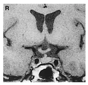 术后1年MRI，影像显示垂体柄及垂体腺完整，未见肿瘤残留。