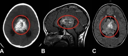 肿瘤伴钙化、瘤内出血，并伴有脑积水。磁共振成像（MRI）显示一个可能起源于透明隔的异质性强化肿瘤，填充在侧脑室和第三脑室的大部分区域。