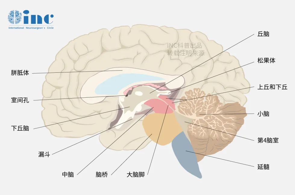 脑动静脉畸形