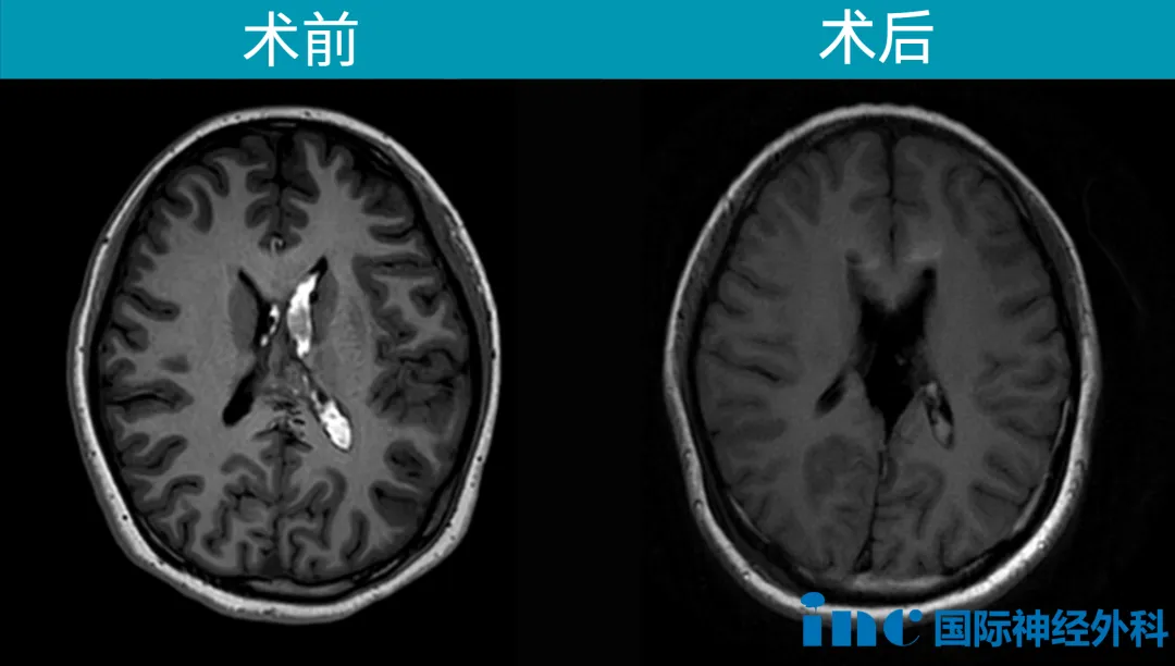 术后MRI图像清楚显示：AVM已被完全切除，脑室内出血也已清除
