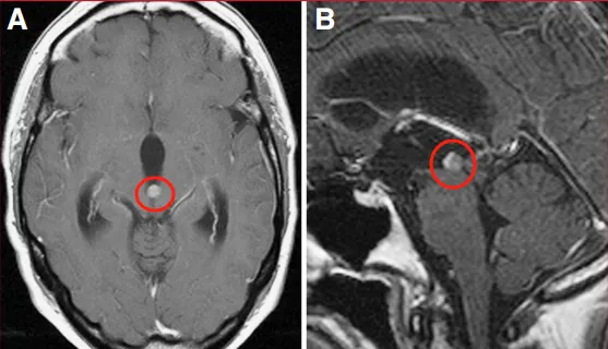 磁共振成像（MRI）显示一小型、明显强化的占位性病变阻塞中脑导水管，导致三脑室性脑积水