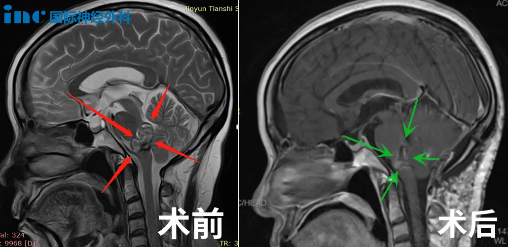 2019年9月，巴教授为黄女士进行了脑干海绵状血管瘤全切手术。整个手术过程顺利，且未损伤周围正常的神经结构。