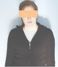 20岁的女孩米亚因剧烈头痛查出一个背侧外生的中<a href='/naoliu/' target='_blank'><u>脑肿瘤</u></a>引起梗阻性<a href='/naojishui/' target='_blank'><u>脑积水</u></a>。