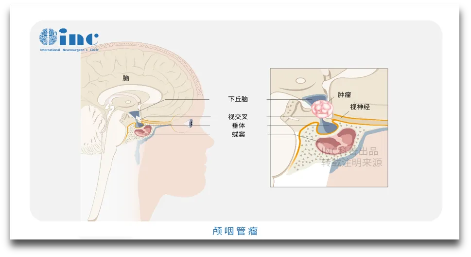 颅咽管瘤不开颅手术