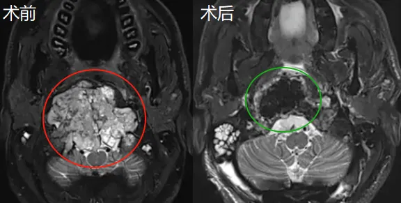 显微镜+神经内镜：成功全切肿瘤