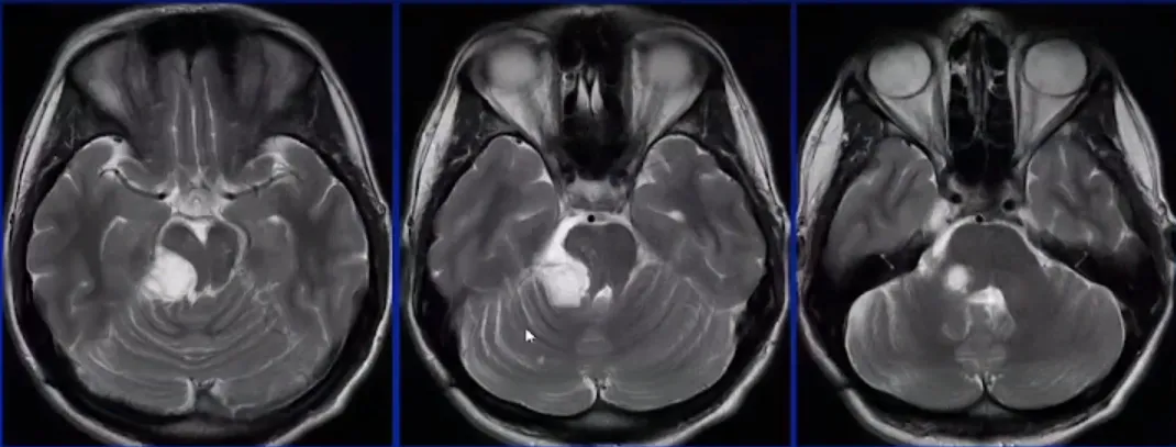 术后MRI