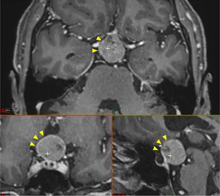 MRI 显示一个球形病变占据垂体漏斗后部及鞍上间隙，且肿瘤与垂体柄和正常垂体组织紧密相邻（黄色箭头）