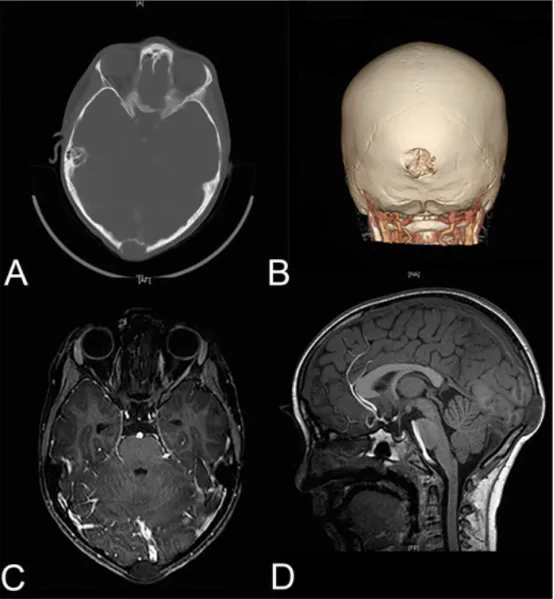 鲁特卡教授通过磁共振成像（MRI）进行进一步研究，MRI显示肿块边界清楚，累及枕骨中线，前部与上矢状窦后下段相接并轻度凹陷，其后部移位，但不侵犯覆盖在头皮上的软组织，脑实质未见异常。CT显示一个不规则的骨髓腔内溶骨性病变。