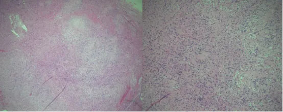组织病理学分析显示一个实性包覆的梭形细胞瘤生长在交错的束状结构中，细胞区和低细胞区交替生长，边缘有骨组织碎片。细胞区域含栅栏状排列的细胞核（安托尼 A 型），交替出现少细胞区域由疏松水肿间质中不规则排列的细胞构成（安托尼 B 型）。