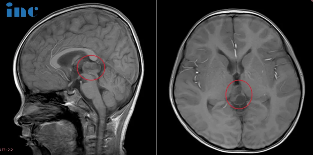 孩子大脑里可能有异常，得进一步做磁共振（MRI）确认。