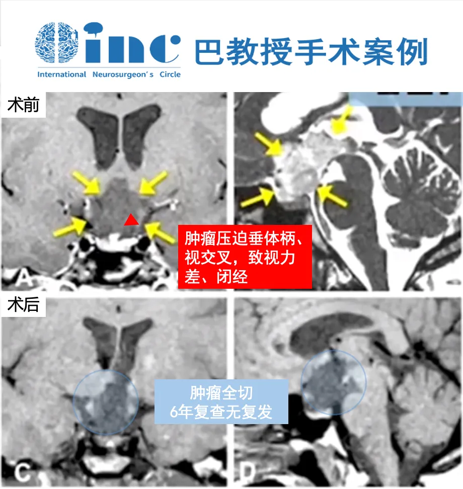 视路胶质瘤治疗突破：手术切除实现6年无复发