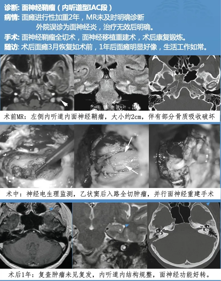 INC巴特朗菲教授面神经鞘瘤案例分享