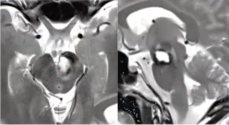 术后MRI