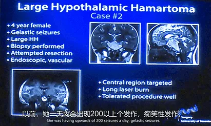 脑瘤“基础”但治疗不简单：“太棒了，女儿至今不复发！”