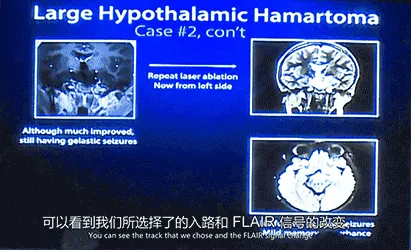 鲁特卡教授认为近几年兴起的一项微创治疗LITT正适合可可的情况。果然，LITT的治疗效果十分明显，两次激光消融手术后，右侧大脑神经的关联被成功切断，可可的癫痫发作从几百个下降至几个。