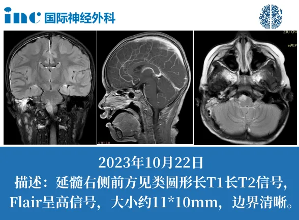 Rutka 教授评估后认为：没有再次手术的指征。在T2序列中，我们可以看到延髓右侧腹侧有一些肿瘤，但增强核磁中的T1序列显示是弥漫性病变，但肿瘤位于脑干的一个重要区域，所有重要的后组颅神经都起源于该区域，因此再次手术对患儿没有帮助。