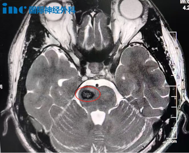 一颗脑干海绵状血管瘤竟破裂出血。此时，他才28岁。