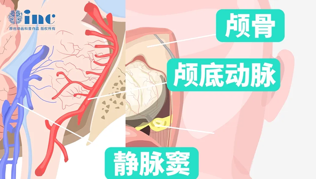 延髓解剖关系复杂、位置深，切除肿瘤时，手术入路需要穿过颅骨，避开颅底动脉、静脉窦、颅神经等，手术难度很高。