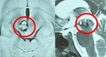 脑干中脑位置关键，不仅是维持生命体征的中枢，更是手术的“禁区”，鲜少有医生敢碰。