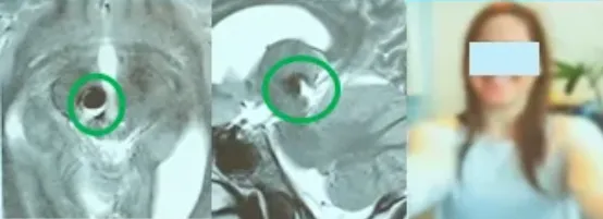 三次收到病危通知的她，经历第四次脑干出血后反而微笑：我一定要战胜疾病！