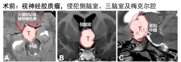 8岁男孩卢卡因视路-下丘脑胶质瘤引起视力受损而就诊，影像显示肿瘤为视路-下丘脑胶质瘤（OPHG），向上突入第三脑室并达室间孔（Monro孔）(A-C)。