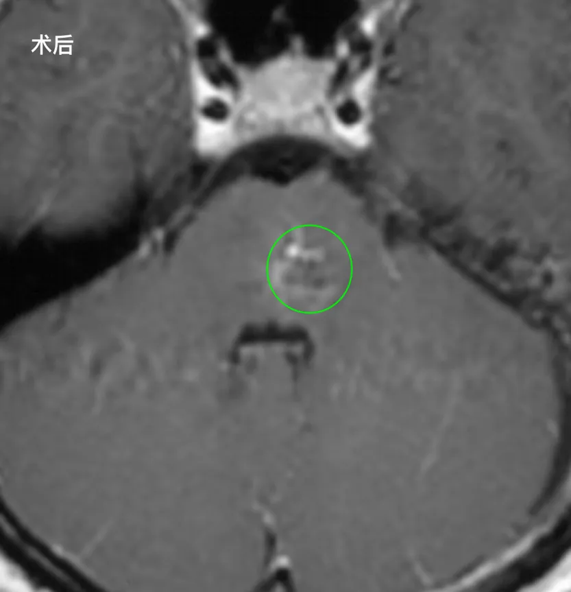术后第 2 天：复查 CT 显示颅内无脑水肿、无新发脑出血，她能清晰说话、吞咽正常，顺利转出普通病房；