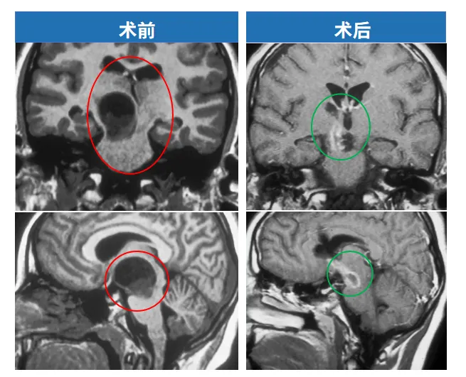 术前术后MRI对比