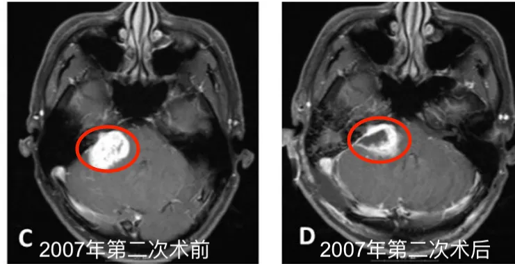 2007年5月第二次切除术前MR图像。D.第二次切除术后1个月MR图像。