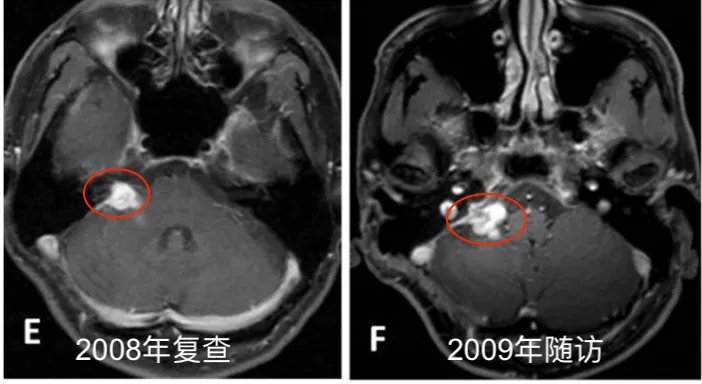 E. 2008年5月随访的MR图像。F.2009年11月随访的MR图像。