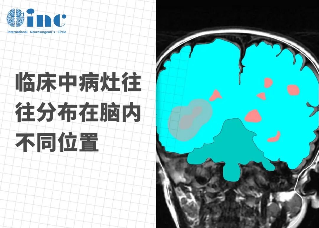 海绵状血管瘤