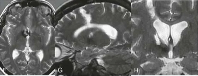 术后CT（E）和MRI（F-H）证实，两个病灶已被完整切除