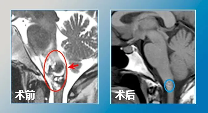 术后9个月，复查MR显示病变全切，脑干组织复位等。