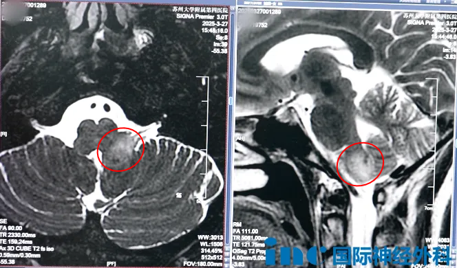 这个胶质瘤长在脑干，“术后可能瘫痪、丧失吞咽功能，你现在能走能跳，为何要冒险？”
