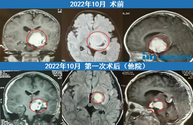 苏苏出现了右侧偏瘫的并发症，直至转院还不能独立行走，只能由父母抱着。