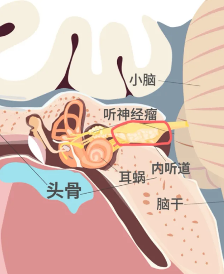 这种肿瘤往往起源于内听道，会慢慢“长大”，一方面把内听道撑宽，形成锥形的“甜筒”；另一方面又向内耳与脑干之间的桥小脑角区扩张，变成圆润的“冰淇淋球”。