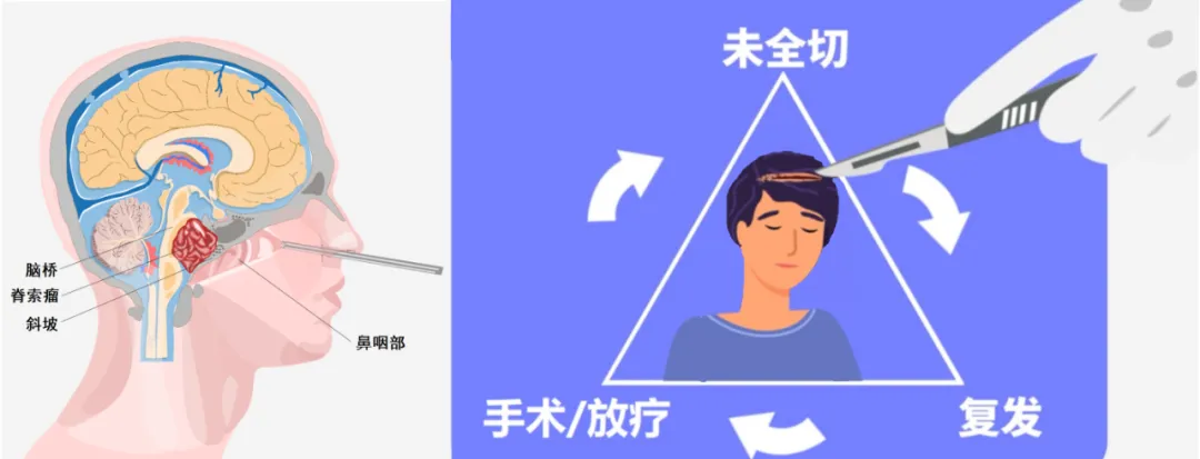 对于脊索瘤患者及其家庭而言，“复发”是一个沉痛的词语——它不仅意味着患者需要再次承受肿瘤的痛楚，同时家属也要面临着极大的心理和经济压力。