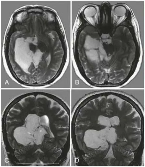 术前MRI