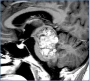 术前MRI