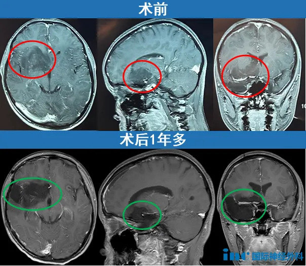 曾经，长于功能区巨大的胚胎发育不良性神经上皮瘤（DNET）成为这个家庭的噩梦，第一次手术的部分切除虽明确了肿瘤的良性，但术后两年，却有一个更加难对付的“家伙”缠上了小欧——癫痫。