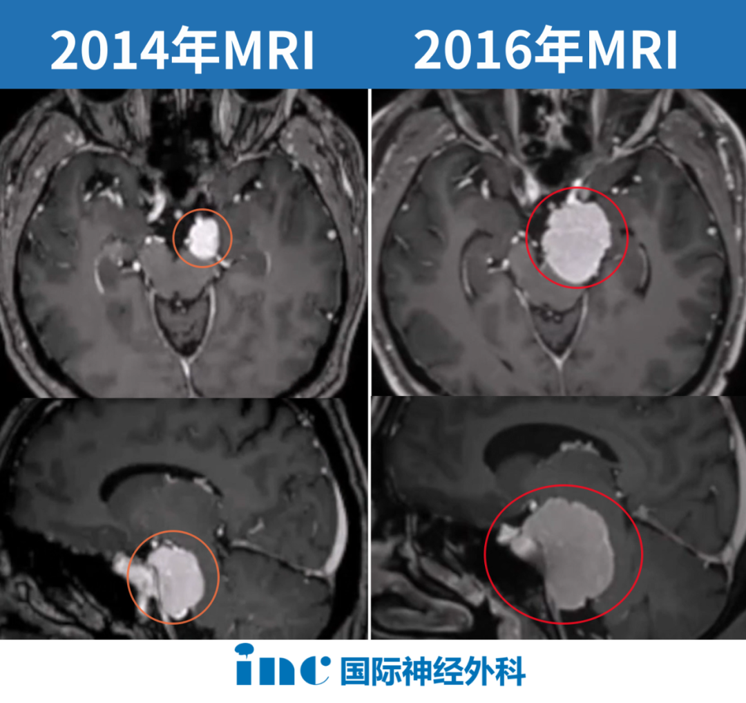 一例岩斜区脑膜瘤，患者出现左侧脸部剧痛、吞咽困难等严重症状。