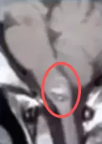 第一次出血 -  基本无症状