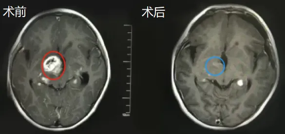 双侧视神经、下丘脑、脑干区域内肿瘤次全切除，仅神经表面参与小部分肿瘤，术中行神经电生理监测、术中神经导航技术，实现安全切除。