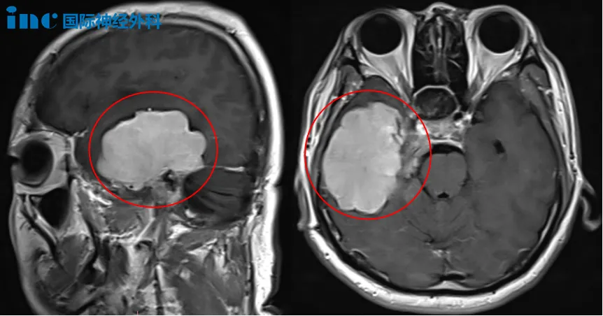 术前MRI