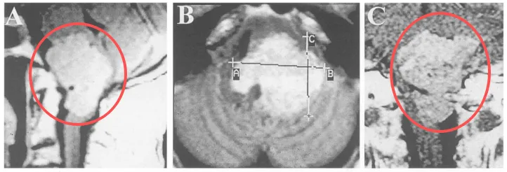 术前MRI 