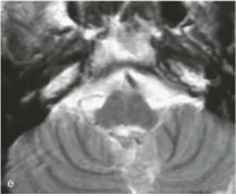 巴教授进行手术，术后 MRI（e）证实肿瘤全切，术后未出现新的神经功能缺损。