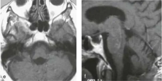 肿瘤为良性室管膜瘤，INC巴教授实现全切（术后 MRI 见 e、f），未新增神经功能障碍。