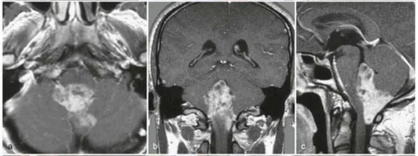 31岁男性患者因颈部疼痛及步态共济失调就诊，术前 MRI（a-c）示第四脑室及背侧颅颈交界区巨大室管膜瘤。